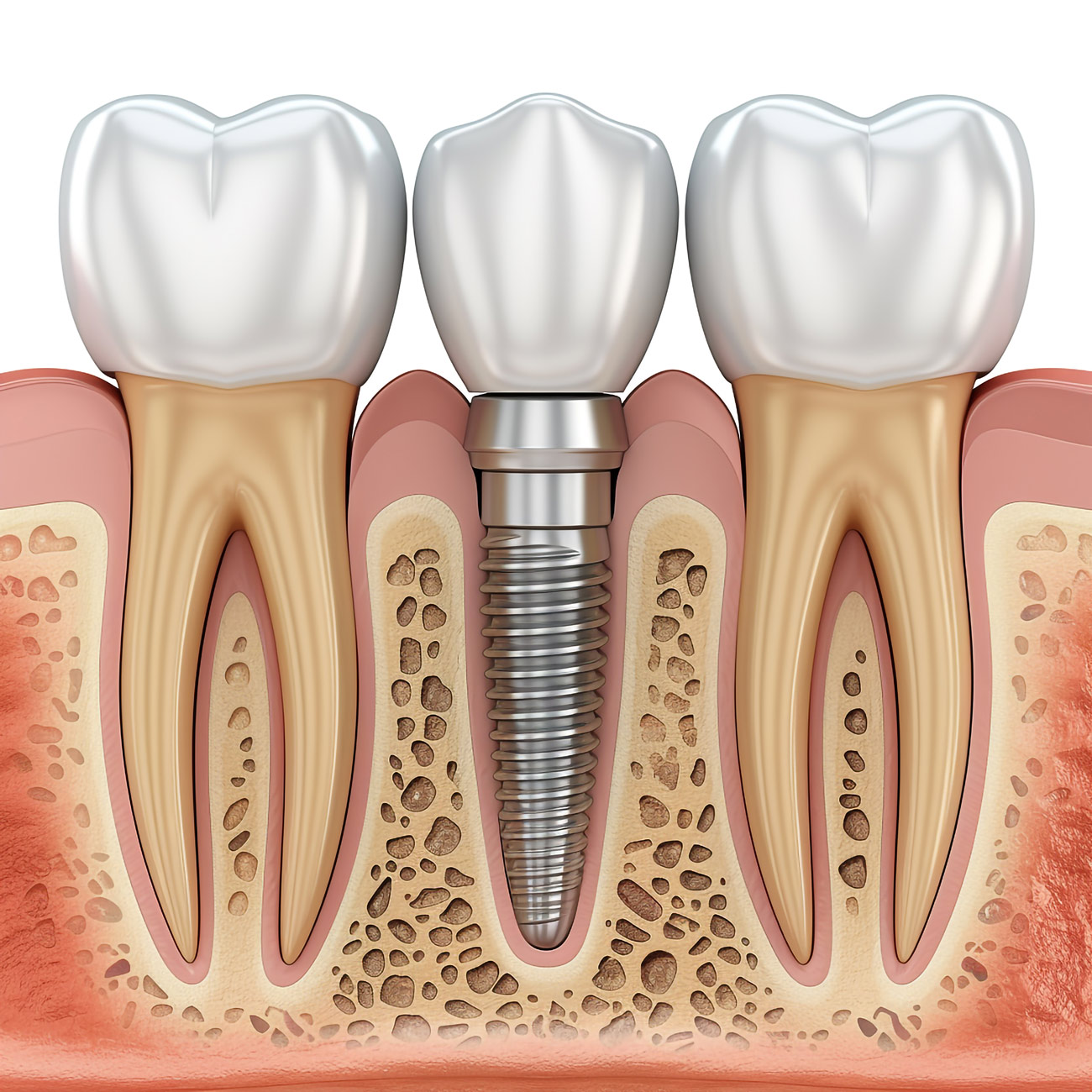 aktif dent implant AKTİF DENT www.aktifdent.com.tr info@colombia.com.tr 05399280551